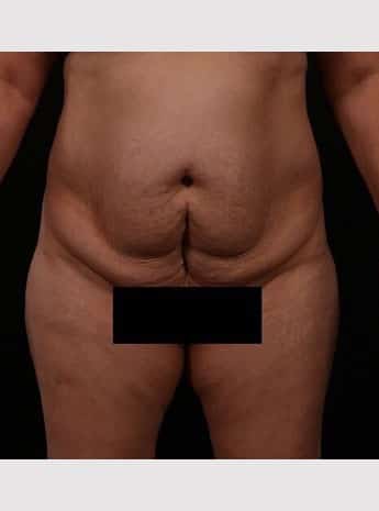 Before Image: Tummy Tuck (Abdominoplasty) - front