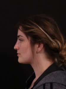 Nonsurgical Rhinoplasty