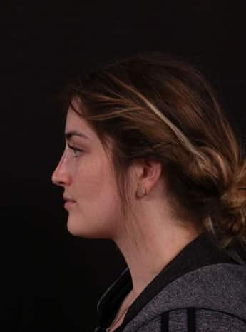 After Image: Nonsurgical Rhinoplasty - left-side
