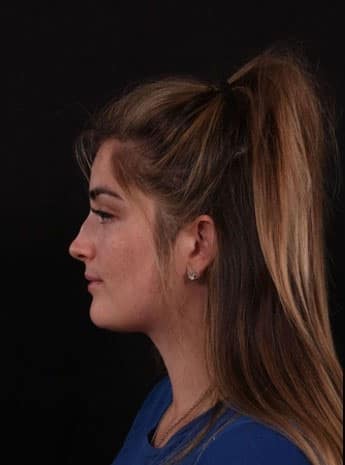 Before Image: Nonsurgical Rhinoplasty - left-side