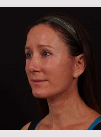 After Image: Facelift - left-front-oblique