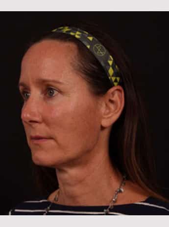 Before Image: Facelift - left-front-oblique