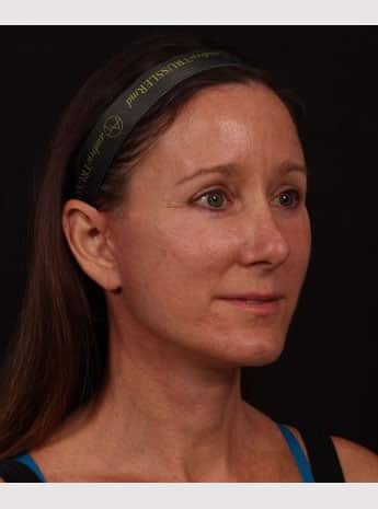 After Image: Facelift - right-front-oblique