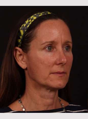 Before Image: Facelift - right-front-oblique