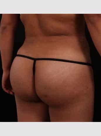 After Image: Brazilian Butt Augmentation (Butt Lift) - right-back-oblique