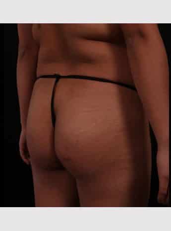 Before Image: Brazilian Butt Augmentation (Butt Lift) - right-back-oblique