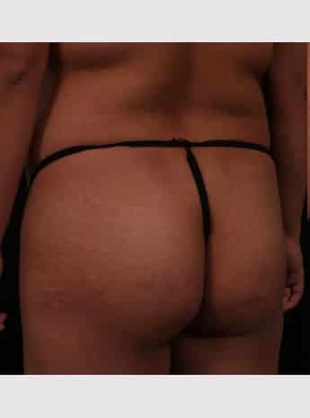 Before Image: Brazilian Butt Augmentation (Butt Lift) - left-back-oblique