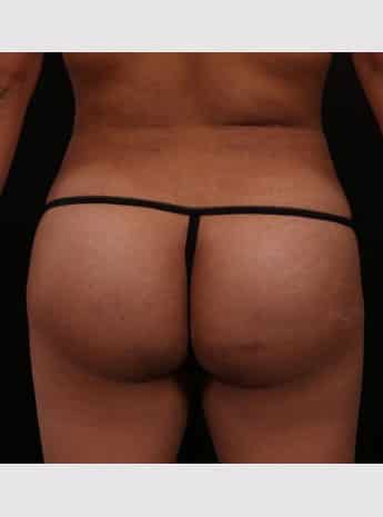 After Image: Brazilian Butt Augmentation (Butt Lift) - back
