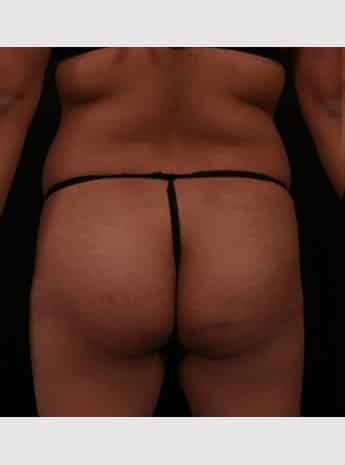 Before Image: Brazilian Butt Augmentation (Butt Lift) - back