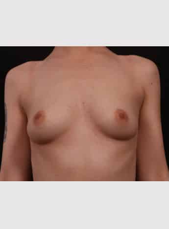 Before Image: Breast Augmentation - front