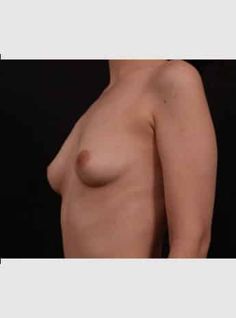 Before Image: Breast Augmentation - left-front-oblique