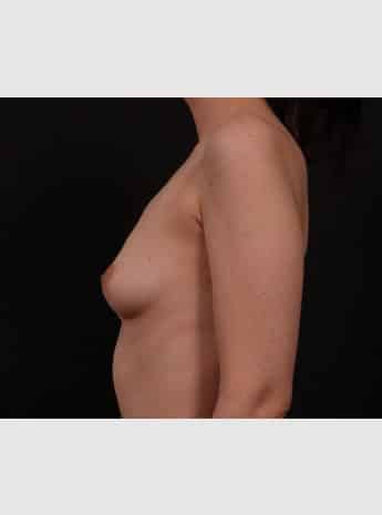 Before Image: Breast Augmentation - left-side