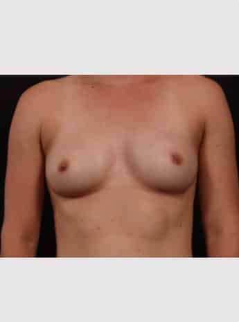 After Image: Inverted Nipple Repair - front