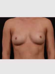 Inverted Nipple Repair