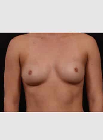 Before Image: Inverted Nipple Repair - front