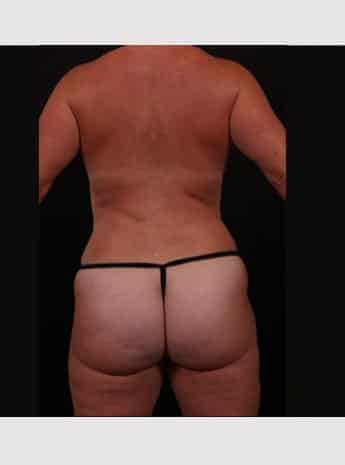 After Image: Mommy Makeover - back