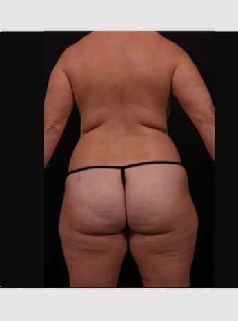 Before Image: Mommy Makeover - back