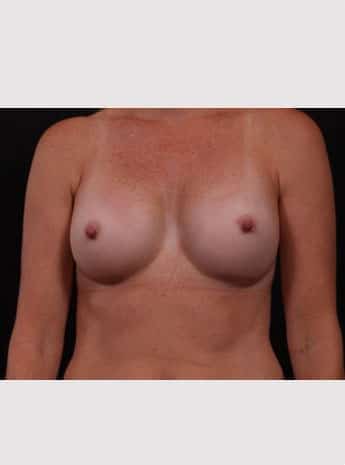 After Image: Breast Augmentation - front