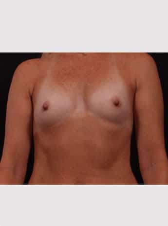 Before Image: Breast Augmentation - front