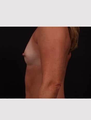 Before Image: Breast Augmentation - left-side