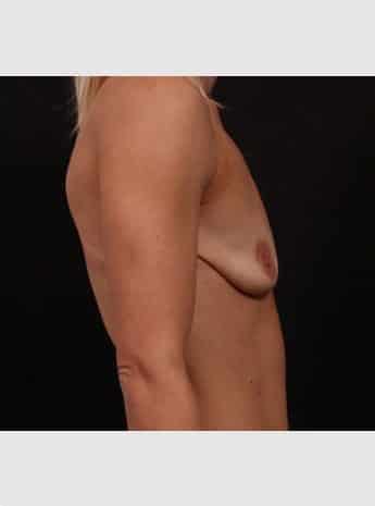 Before Image: Periareolar Lift (Mastopexy) with Augmentation - right-side