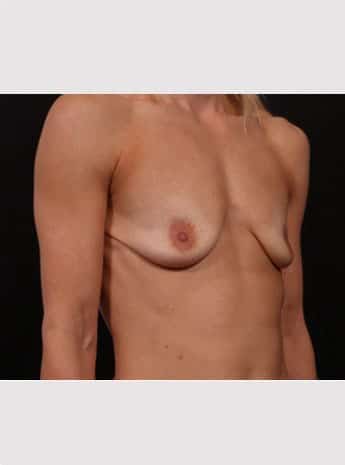 Before Image: Periareolar Lift (Mastopexy) with Augmentation - right-front-oblique