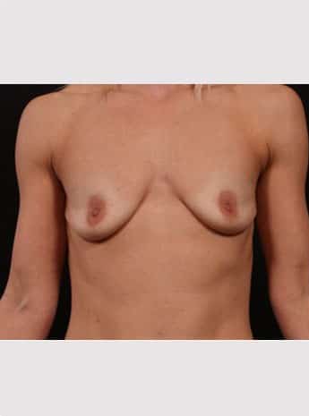 Before Image: Periareolar Lift (Mastopexy) with Augmentation - other