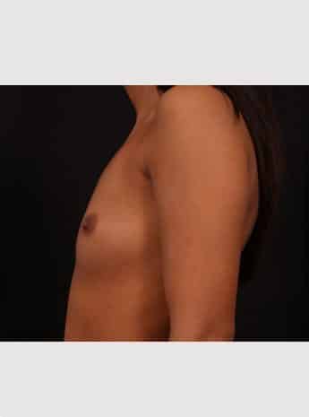 Before Image: Breast Augmentation - left-side