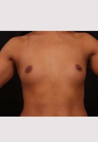 Before Image: Breast Augmentation - left-side