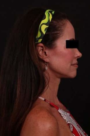 After Image: Neck Lift / Lower Facelift - right-side