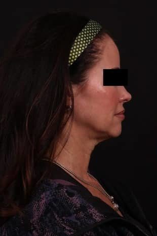 Before Image: Neck Lift / Lower Facelift - right-side