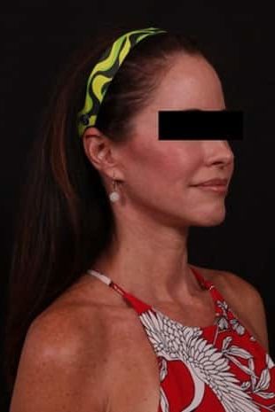 After Image: Neck Lift / Lower Facelift - right-side