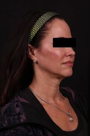 Before Image: Neck Lift / Lower Facelift - right-side