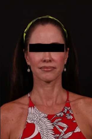 After Image: Neck Lift / Lower Facelift - front
