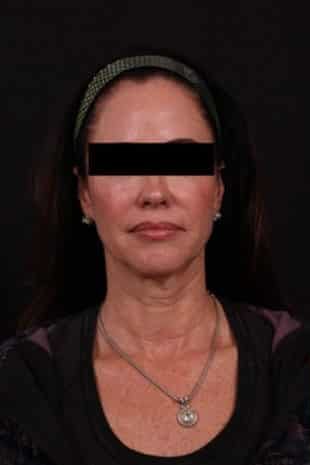Before Image: Neck Lift / Lower Facelift - front