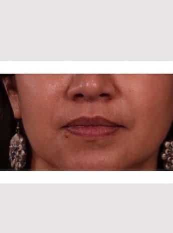 After Image: Lip Lift - front