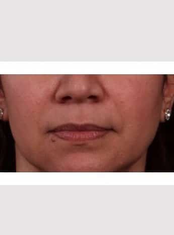 Before Image: Lip Lift - front