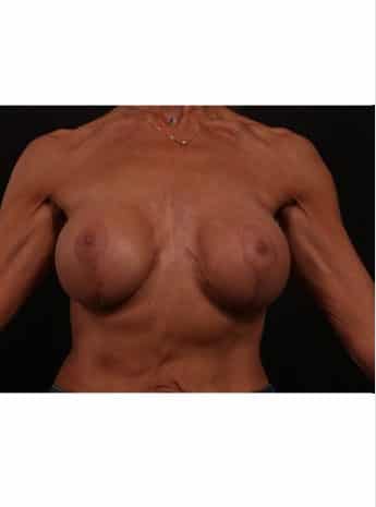 After Image: Secondary Breast Surgery - front