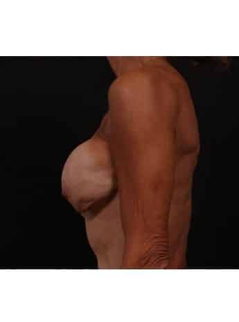Before Image: Secondary Breast Surgery - left-side