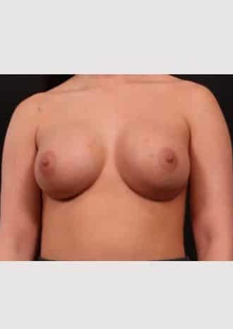After Image: Primary Breast Augmentation - front