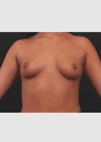 Primary Breast Augmentation
