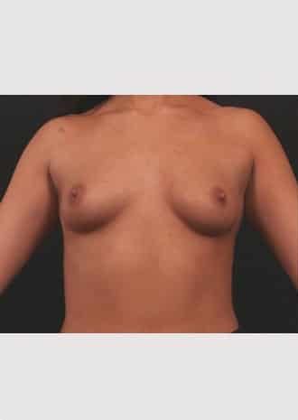 Before Image: Primary Breast Augmentation - front