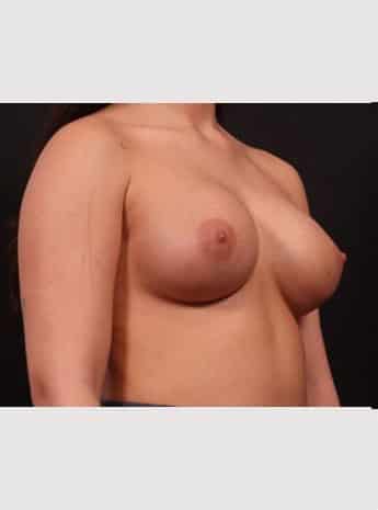 After Image: Primary Breast Augmentation - right-front-oblique