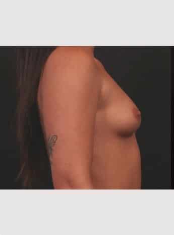 Before Image: Primary Breast Augmentation - right-side