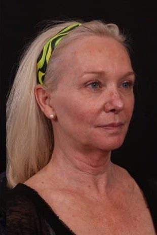Before Image: Neck Lift / Lower Facelift - right-front-oblique