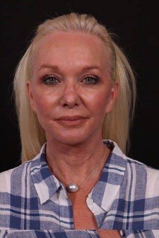 After Image: Neck Lift / Lower Facelift - front