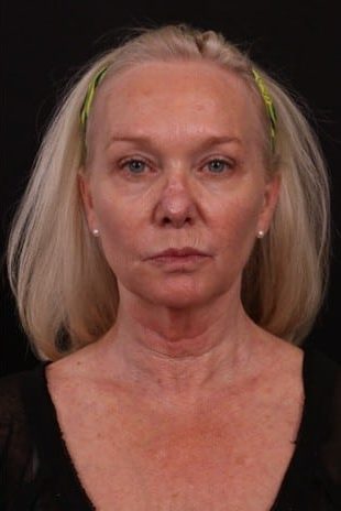 Before Image: Neck Lift / Lower Facelift - front