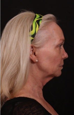 Before Image: Neck Lift / Lower Facelift - right-side