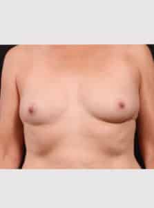 Inverted Nipple Repair