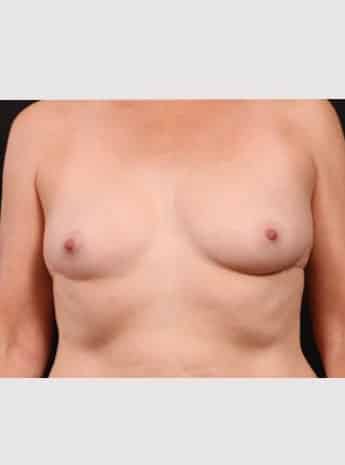 After Image: Inverted Nipple Repair - front
